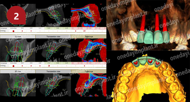 ایمپلنت در یک روز -R2gate-dionavi-روش دیجتالی ایمپلنت دندان- مرکز تخصصی کاشت ایمپلنت در شیراز